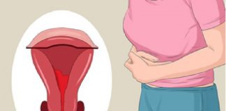 Ciwon Mara Lokacin Al’ada Ciwon mara lokacin al'ada