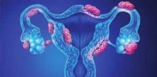 Ciwon Kumburi ɓangaren Mahaifar Mace (Pelvic Inflammation Disease (PID))