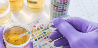 Bayayanar Nau’in Abinci Mai Gina Jiki A Cikin Fitsare (Proteinuria) Bayayanar Nau'in Abinci Mai Gina Jiki A Cikin Fitsare (Proteinuria)