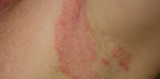 Ƙaiƙayin Matsematsi (Jock itch) Ƙaiƙayin Matsematsi (Jock itch)