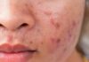 Ƙurajan Pimples Ƙurajan Pimples