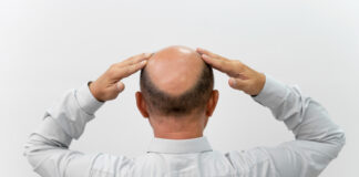 Saiƙo Ko Sanƙo (Baldness)
