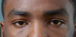 Harara Garke (STRABISMUS)