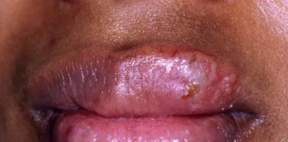 Hucewar Zazzaɓi (HERPES SIMPLEX)