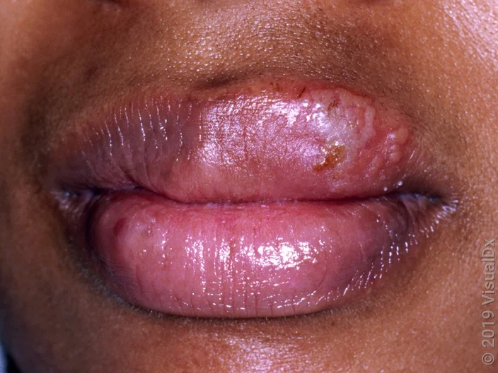 Hucewar Zazzaɓi (HERPES SIMPLEX)