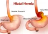 Menene Hiatal Hernia?