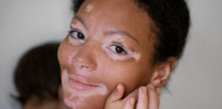 Yadda Lalurar Mele (Vitiligo) Take