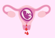Zubar Jini A Cikin Wata Uku Na Farkon Samun Juna Biyu (FIRST TRIMESTER HAEMORRHAGE)