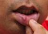 Yadda Ciwon Baki Yake (Mouth ulcers)