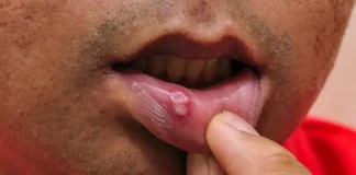 Yadda Ciwon Baki Yake (Mouth ulcers)